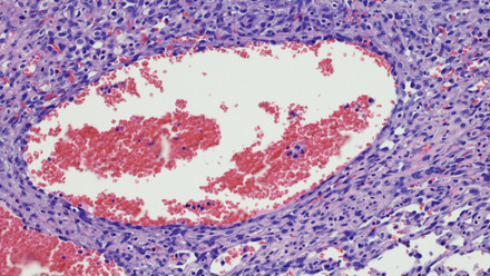 Angiosarcoma_cancer_rare disease.jpg