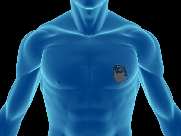 Pulse Generator Pacemaker Real FDA Down-Classifies External Pacemaker Pulse Generator Devices and PSAs ...
